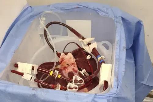 أعضاء خنزير معدلة جينياً موضوعة في حاوية طبية، تُستخدم في تجارب زراعة الأعضاء البشرية، مع أنابيب توصيل وأجهزة طبية.